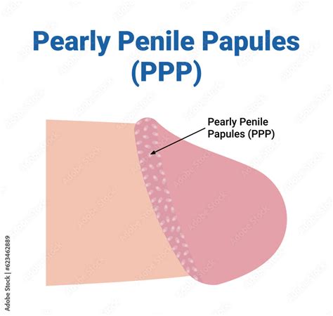 PPP: Pearly Penile Papules Facts and Treatment